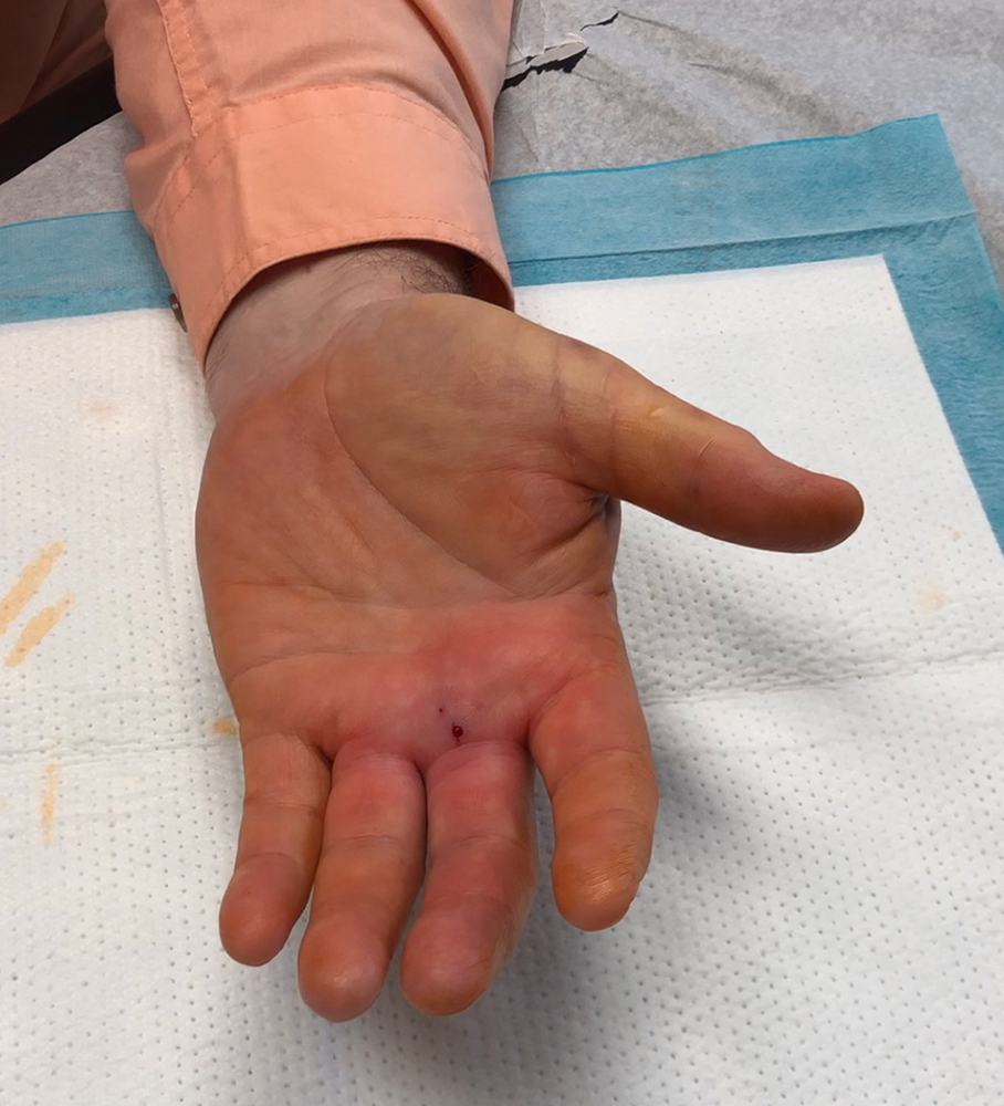 Trigger Finger